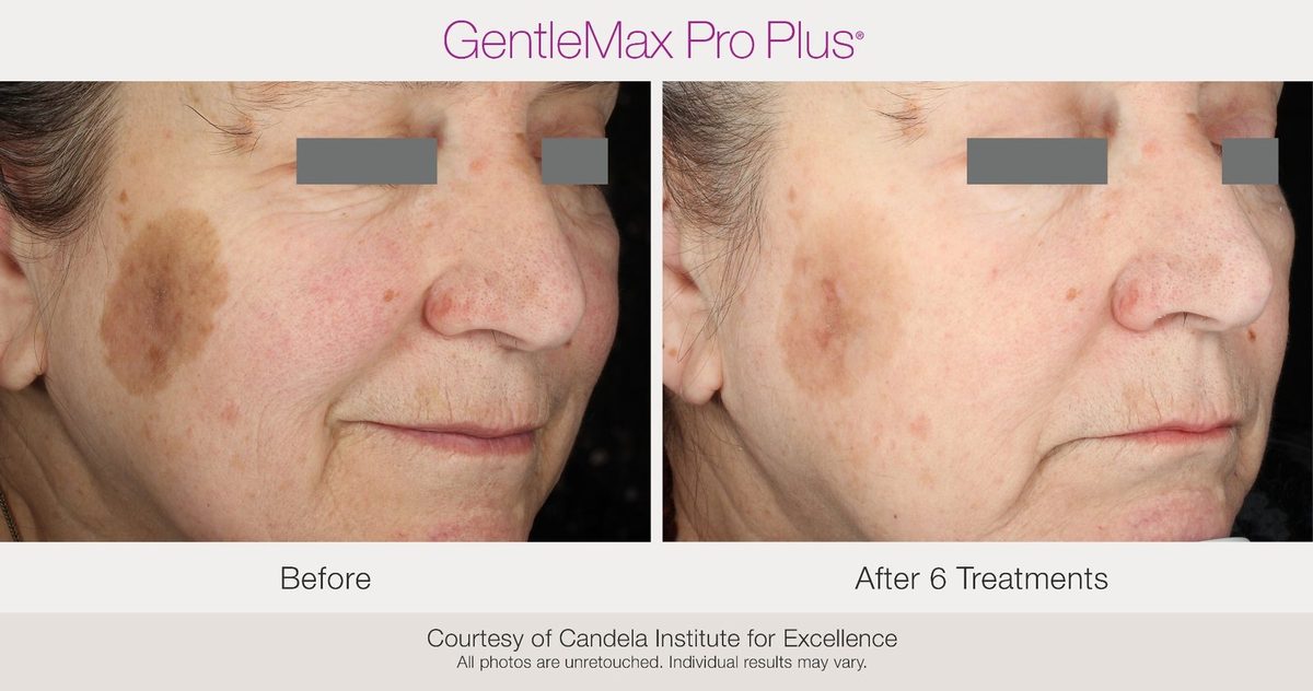 Candela laser treatment for dark spots and age spots at Maison Zolara, Lansing MI