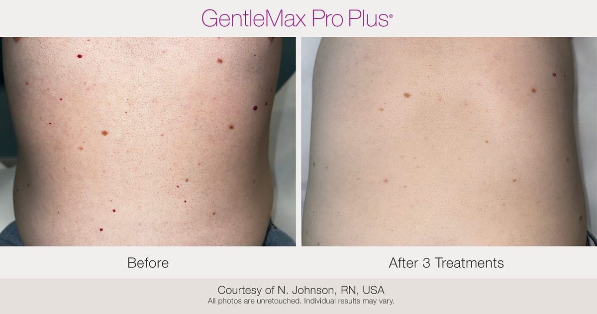 Before and after vascular lesion clearance results using the Candela GentleMax Pro Plus