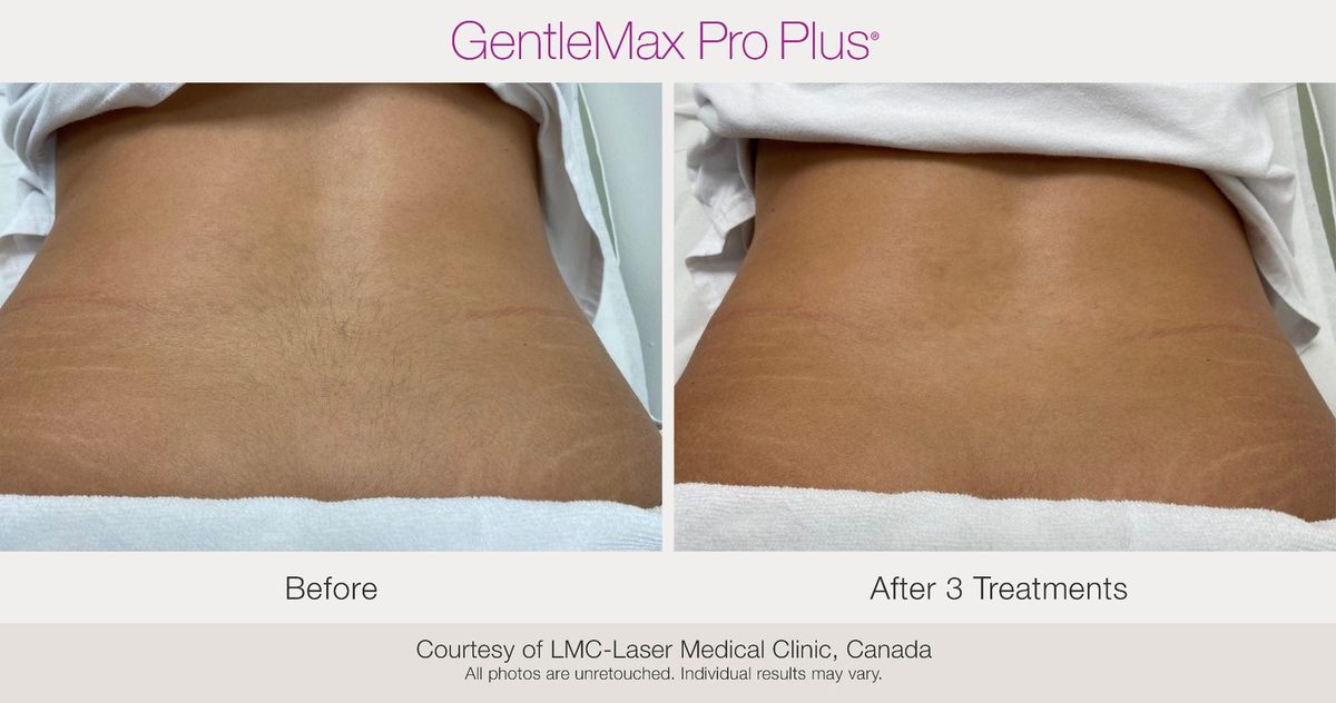 Before and after results showing improvement in lower back skin after 3 treatments