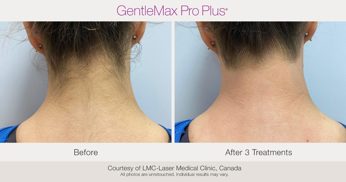 Before and after results showing skin improvement on the neck after 3 treatments