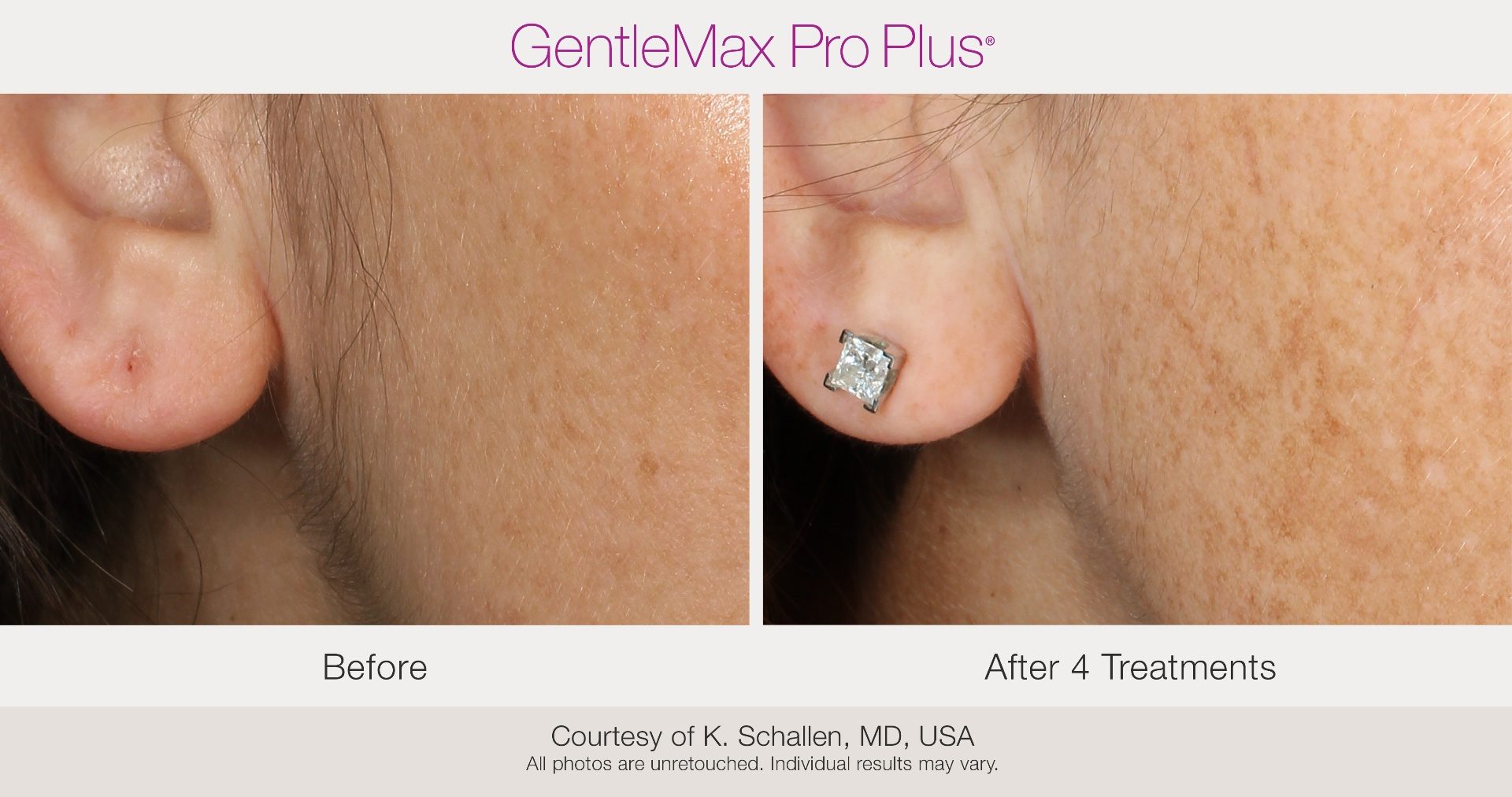Before and after results showing sun spot reduction on the cheek