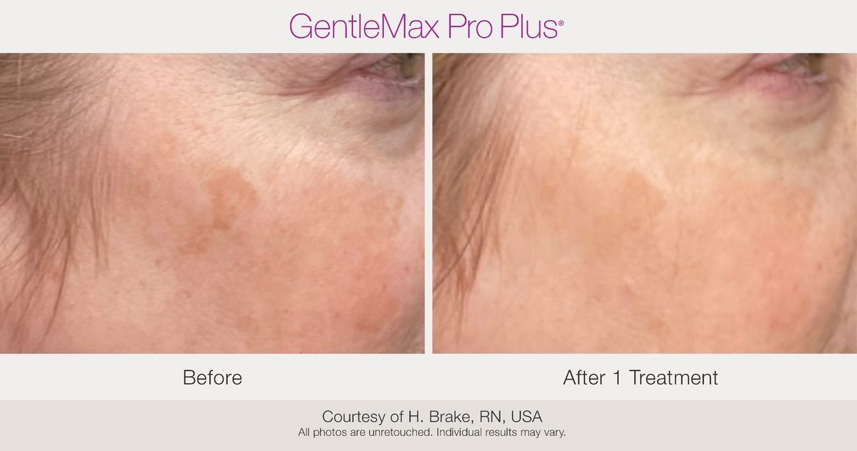 Before and after results showing sun spot reduction after one laser treatment